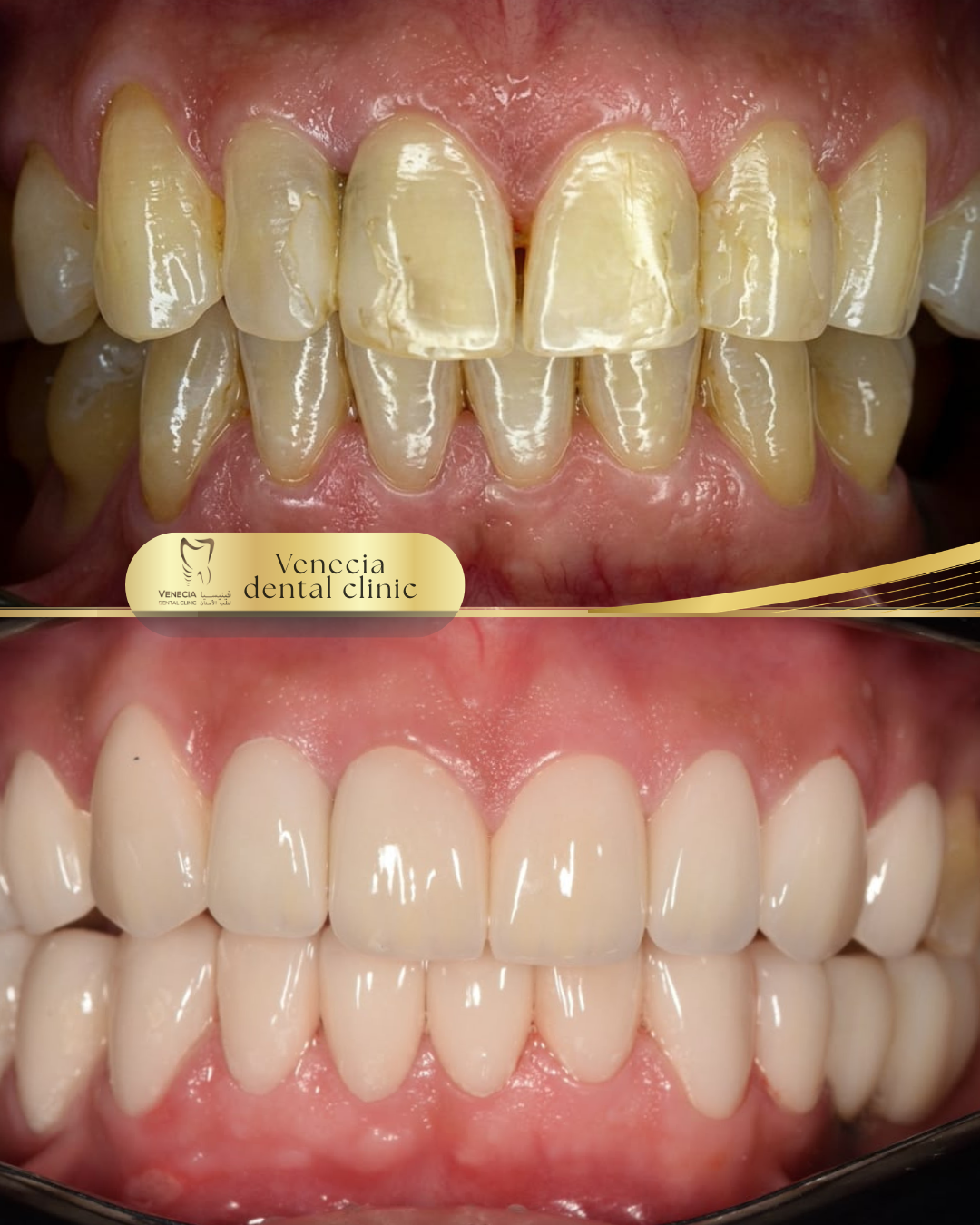 Before and after veneer case 1