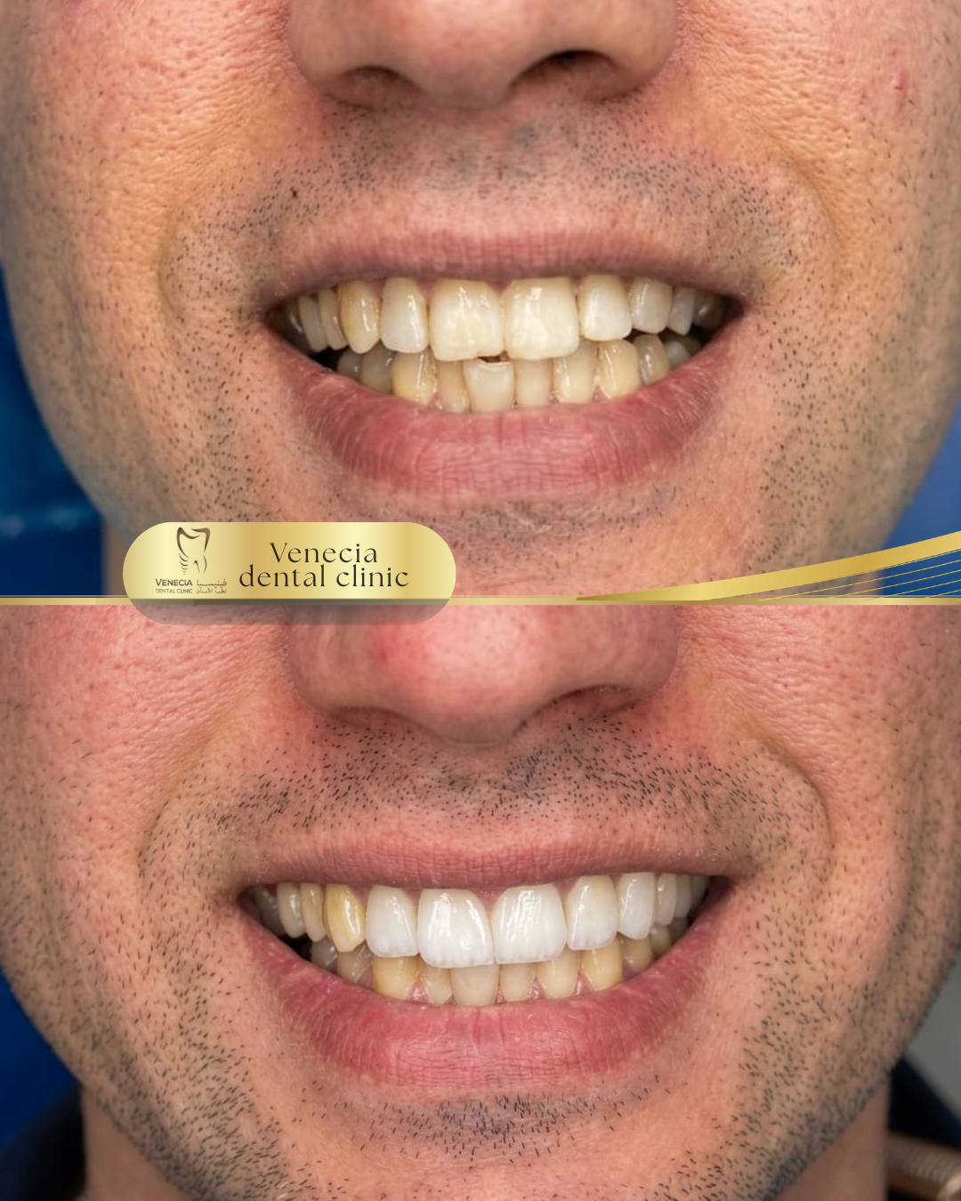 Before and after veneer case 2