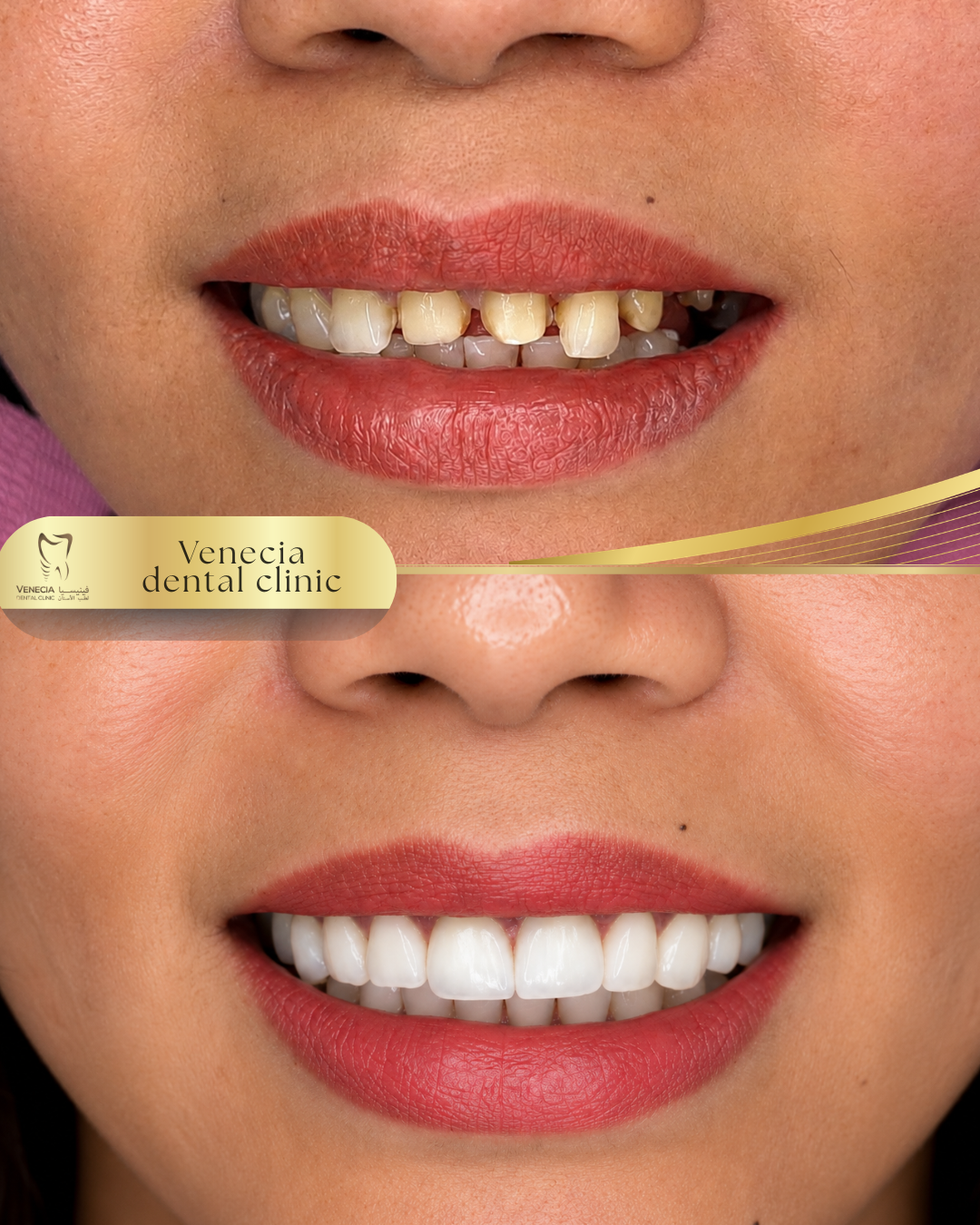 Before and after veneer case 3