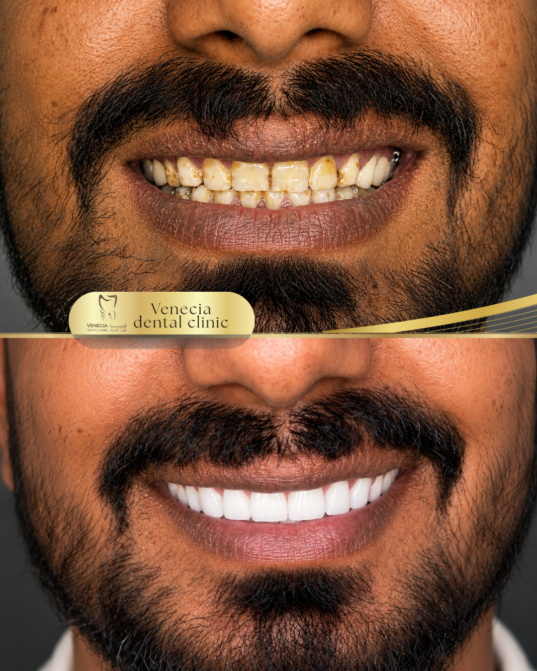 Before and after veneer case 4