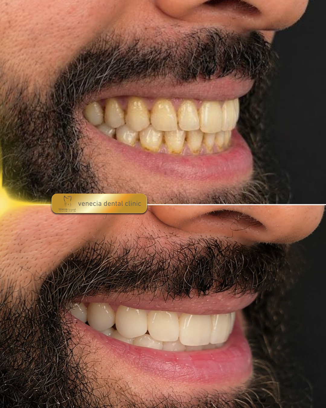 Before and after veneer case 5