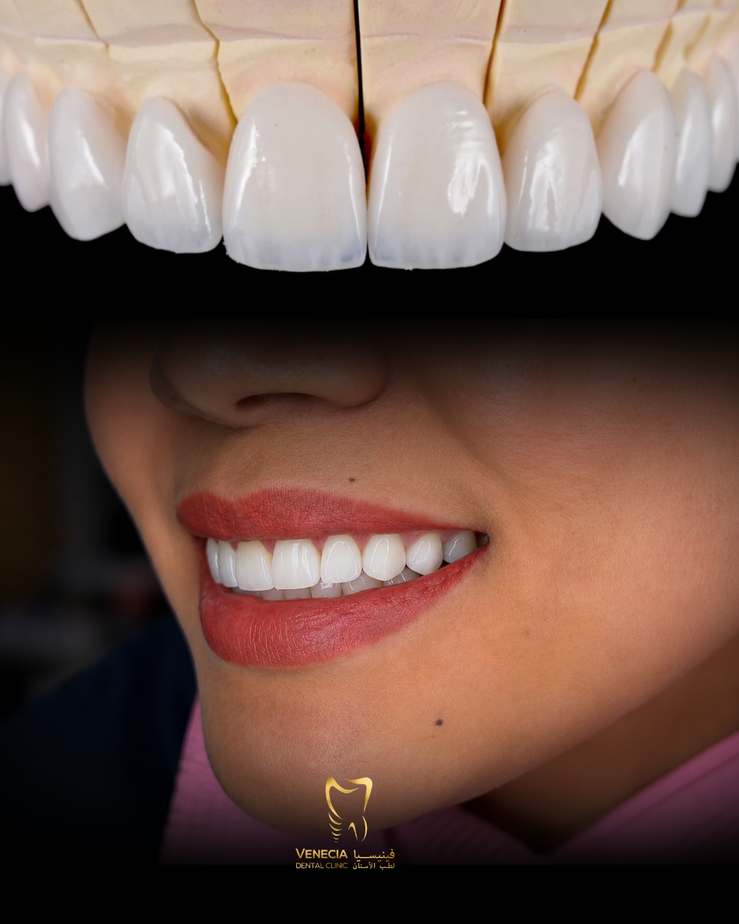 Venecia veneer smile result
