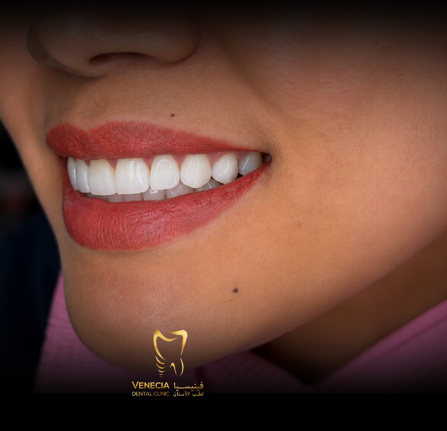 Smiling veneer patient result